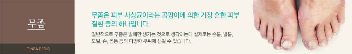 무좀 - 무좀은 피부 사상균이라는 곰팡이에 의한 가장 흔한 피부질환 중의 하나입니다. 일반적으로 무좀은 발에만 생기는 것으로 생각하는데 실제로는 손톱, 발톱, 모발, 손, 몸통 등의 다양한 부위에 생길 수 있습니다.