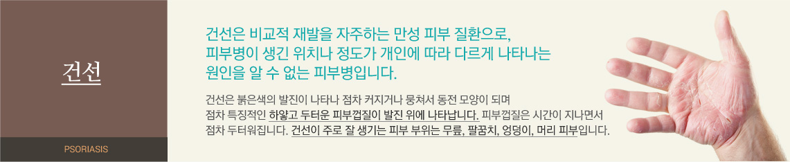 건선 - 건선은 비교적 재발을 자주하는 만성 피부 질환으로, 피부병이 생긴 위치나 정도가 개인에 따라 다르게 나타나는 원인을 알 수 없는 피부병입니다. 건선은 붉은색 발진이 나타나 점차 커지거나 뭉쳐서 동전 모양이 되며 점차 특징적인 하얗고 두터운 피부껍질이 발진 위에 나타납니다. 피부껍질은 시간이 지나면서 점차 두터워집니다. 건선이 주로 잘 생기는 피부 부위는 무릎, 팔꿈치, 엉덩이, 머리 피부입니다.