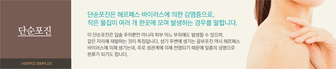 단순포진 - 단순포진은 헤르페스 바이러스에 의한 감염증으로, 작은 물집이 여러 개 한곳에 모여 발생하는 경우를 말합니다. 이 단순포진은 입술 주위뿐만 아니라 피부 어느 부위에도 발생할 수 있의며, 같은 자리에 재발하는 것이 특징입니다. 성기 주변에 생기는 음부포진 역시 헤르페스 바이러스에 의해 생기는데, 주로 성관계에 의해 전염되기 대무에 일종의 성병으로 분류가 되기도 합니다.