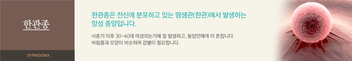 한관종은 전신에 분포하고 있는 땀샘관(한관)에서 발생하는 양성 종양입니다. 사춘기 이후 30~40대 여성의눈가에 잘 발생하고, 동양인에게 더 흔합니다. 비립종과 모양이 비슷하여 감별이 필요합니다. 