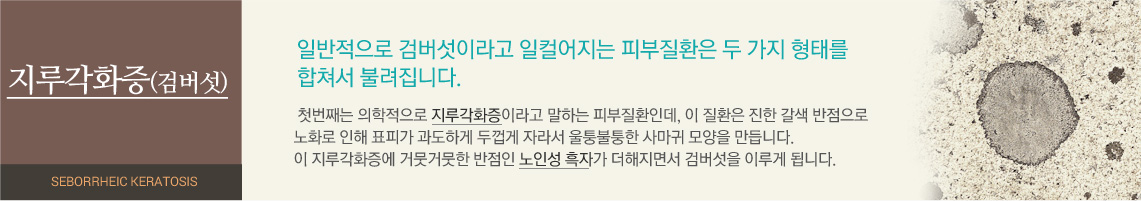 일반적으로 검버섯이라고 일컬어지는 피부질환은 두 가지 형태를 합쳐서 불려집니다. 첫번째는 의학적으로 지루각화증이라고 말하는 피부질환인데, 이 질환은 진한 갈색 반점으로 노화로 인해 표피가 과도하게 두껍게 자라서 울퉁불퉁한 사마귀 모양을 만듭니다. 이 지루각화증에 거뭇거뭇한 반점인 노인성 흑자가 더해지면서 검버섯을 이루게 됩니다.